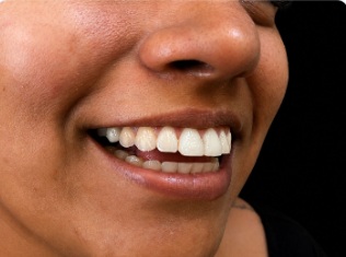 Depois do implante dentário - sorriso renovado e natural