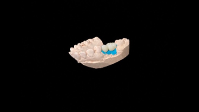 Modelo de implante dentário unitário com coroa em cerâmica