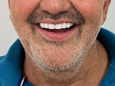 Sorriso recuperado e firme com protocolo dentário